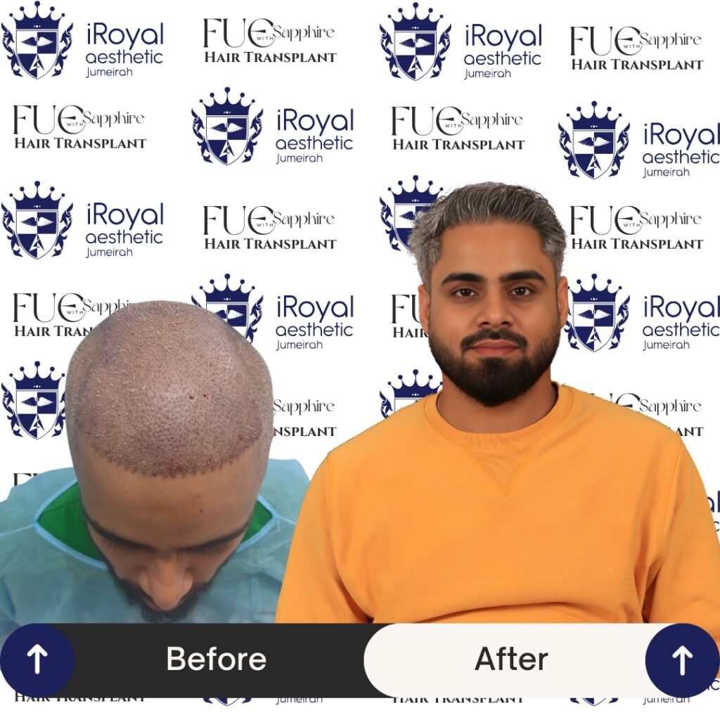 Hair Transplant Before & After Results - Dubai