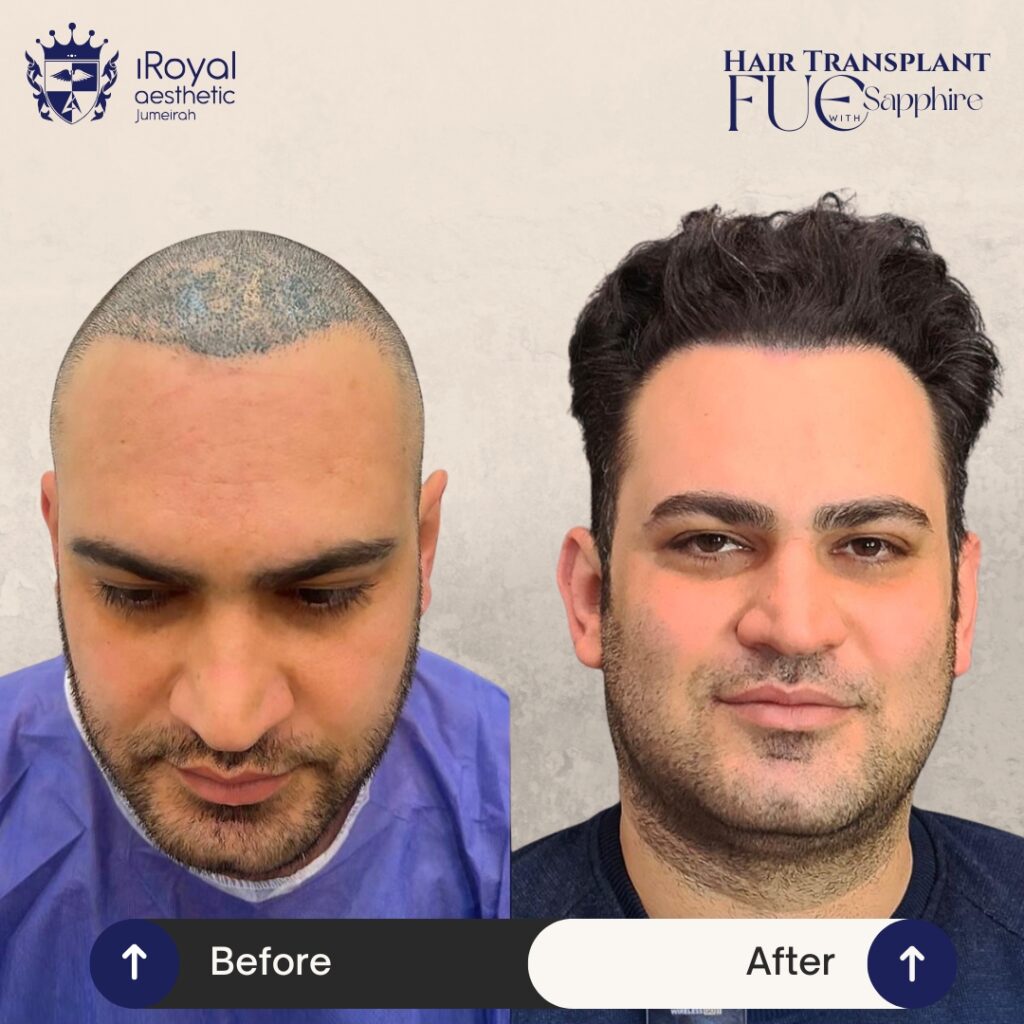 Hair Transplant