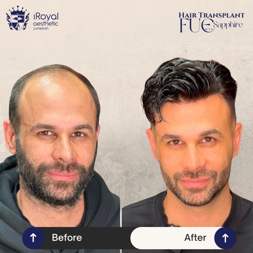 iRoyal Hair Transplant
