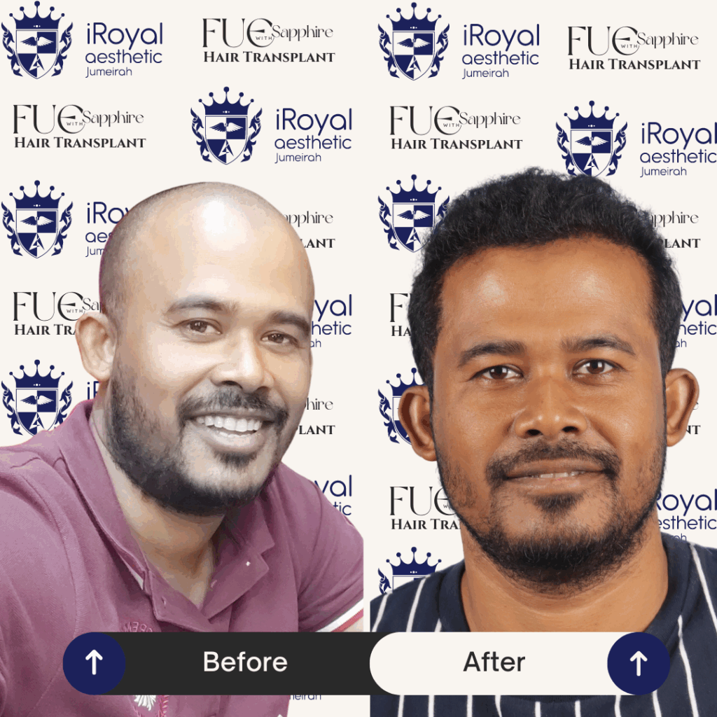 Hair Translplant | iRoyal Aesthetic-Dubai